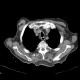 Skin folds, mimic of pneumothorax, PNO: CT - Computed tomography